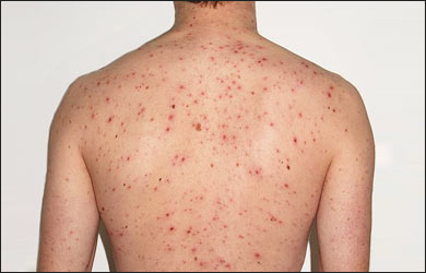Types of Skin Rashes - Pictures, Terms, Diagnosis and ...
