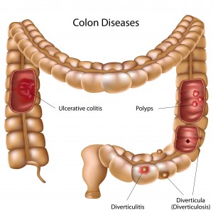ulcerative colitis