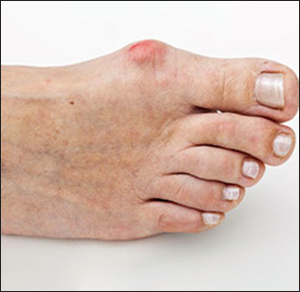 Hallux-Rigidus Hallux-Rigidus