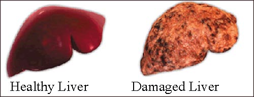 Liver Disease