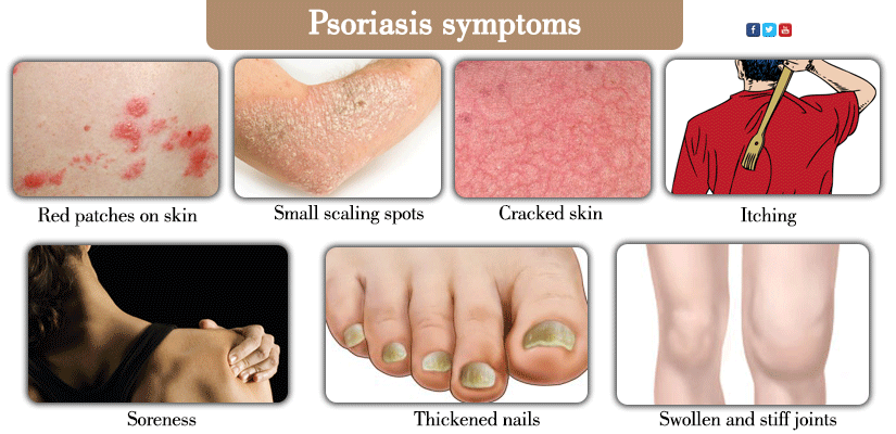 psoriasis-symptoms