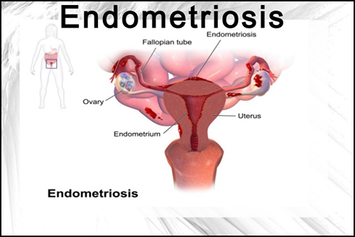 diseases-female-reproductive-system