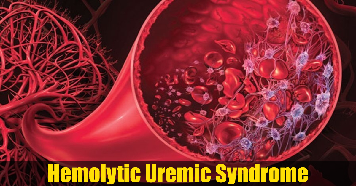 Hemolytic-Uremic-Syndrome