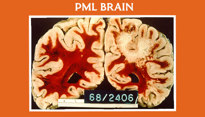 PML-BRAIN