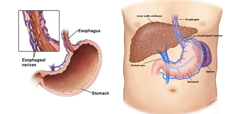 esophageal-varices