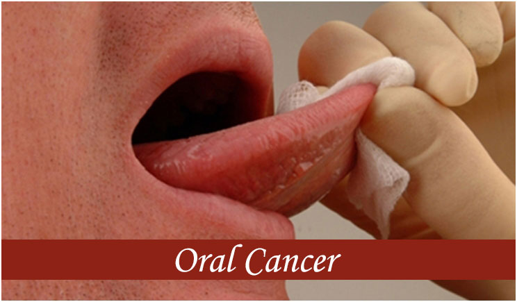 Oral-Cancer