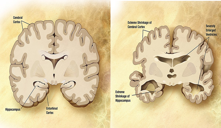 Treatment of Alzheimer's Disease