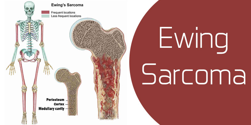 Ewing-sarcoma2
