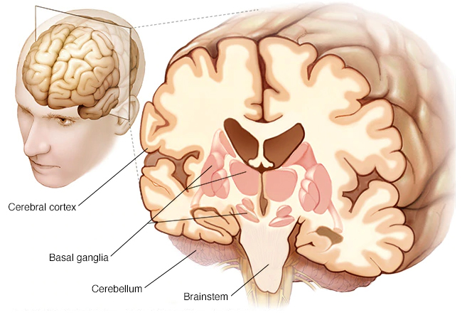 Progressive Supranuclear palsy