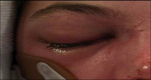 Mucormycosis Fungal Infection Archives | Dr. Vikram Chauhan's Blog