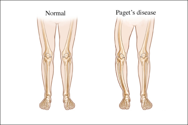 Paget's Disease