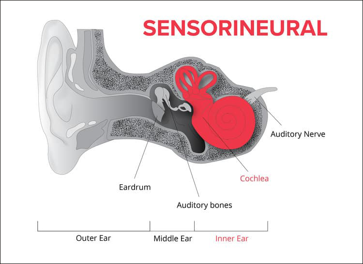 Sensorineural Hearing Loss 