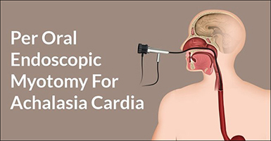 Achalasia-Cardia