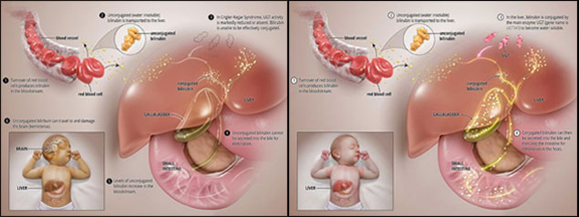 Crigler Najjar Syndrome Type 1