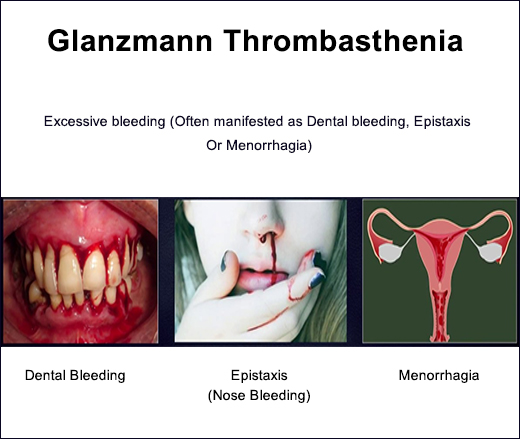 Glanzmann Thrombasthenia