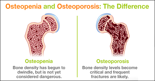 Osteopenia & Osteoporosis