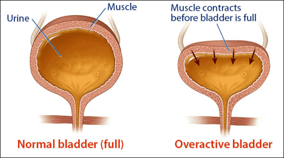 Overactive Bladder