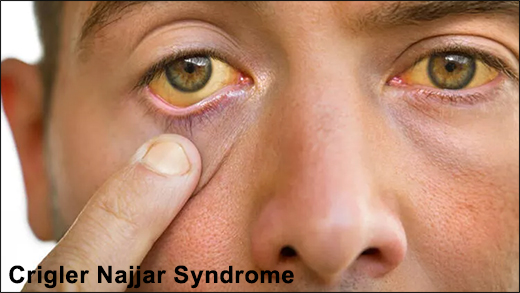 Crigler Najjar Syndrome