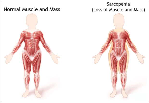 Sarcopenia