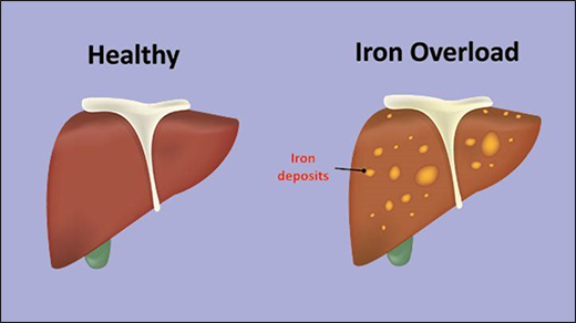 Iron Overload Disorder