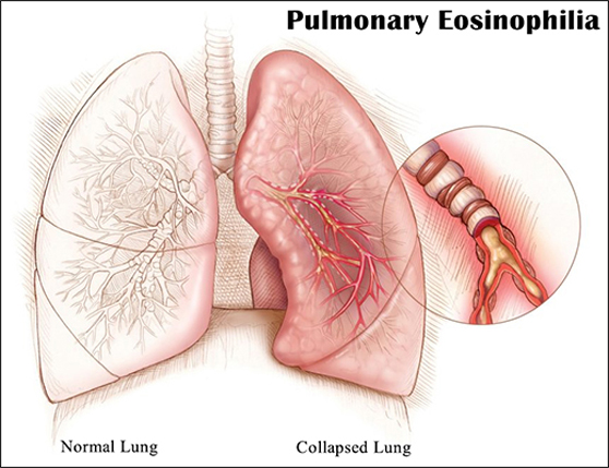 Eosinophilic lung disease