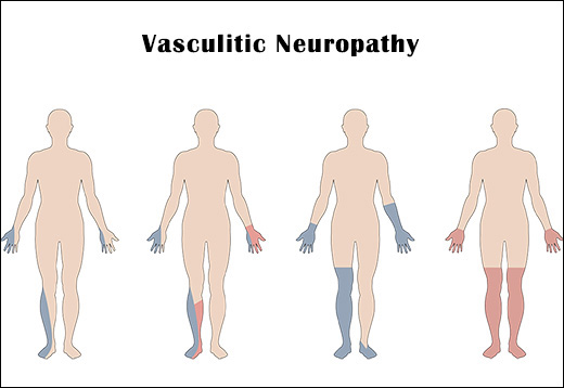 Vasculitic Neuropathy