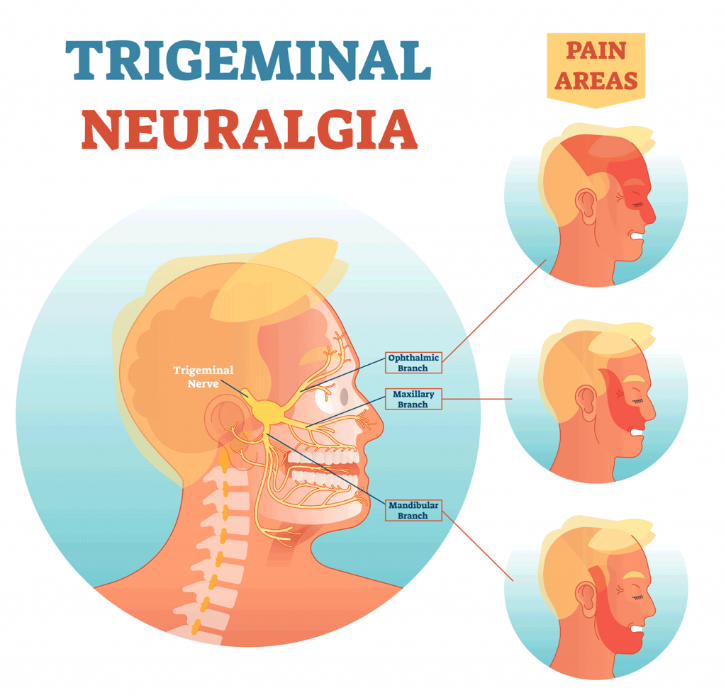 Trigeminal Neuralgia