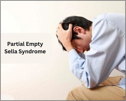 Partial Empty Sella Syndrome 