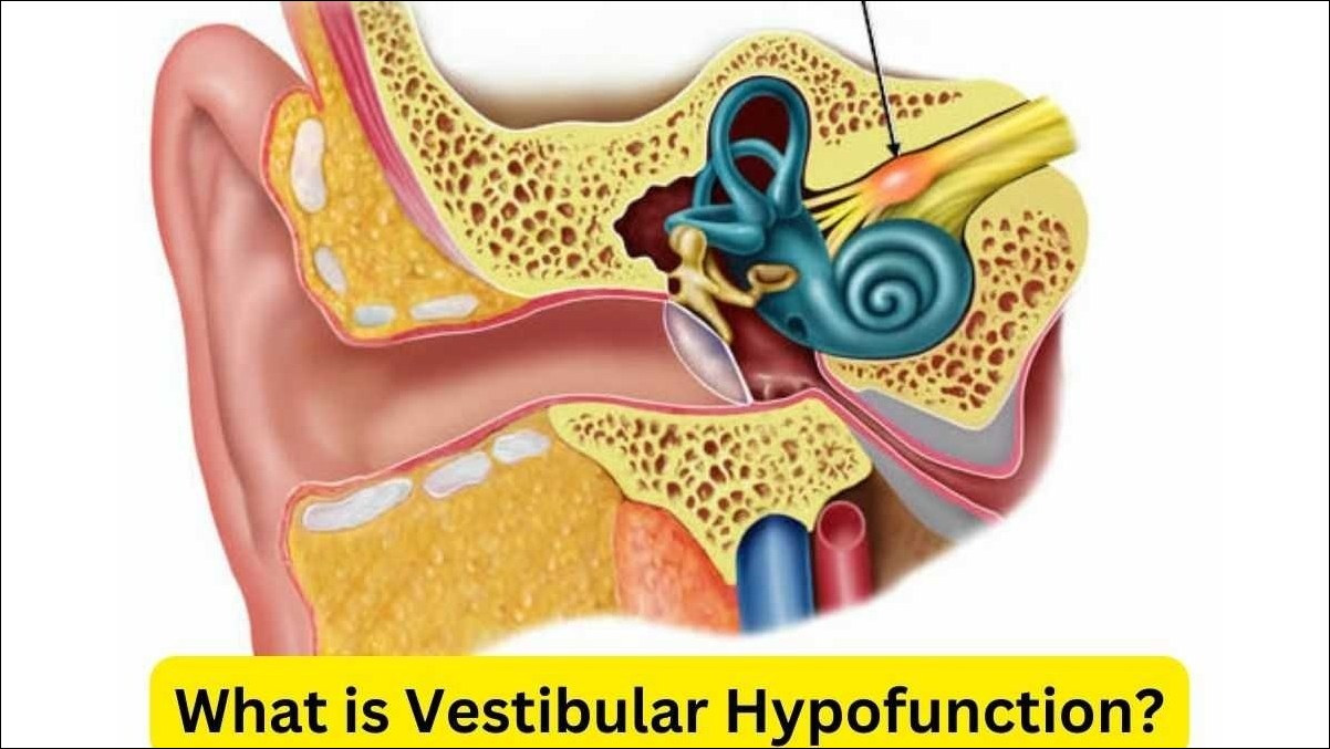 Vestibular Hypofunction 