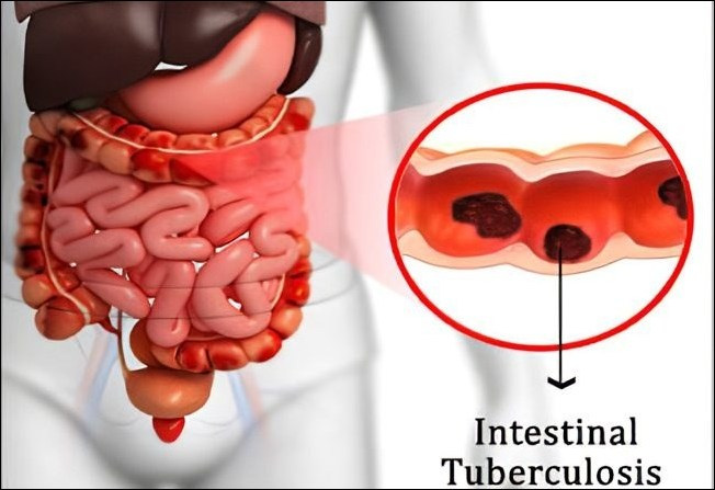 Intestinal Tuberculosis 
