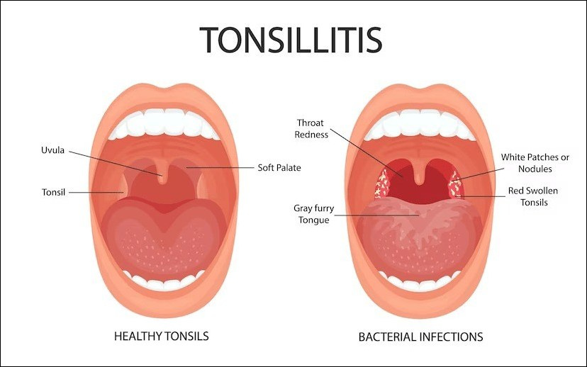 Tonsillitis