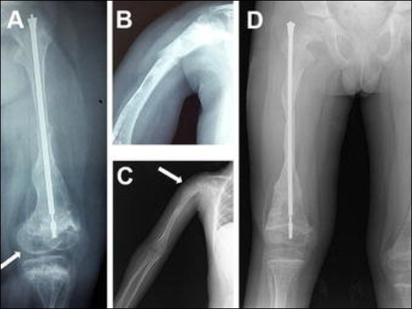 Osteogenesis Imperfecta/Brittle Bone Disease
