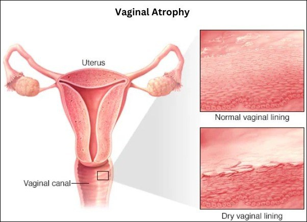 Vaginal Atrophy 