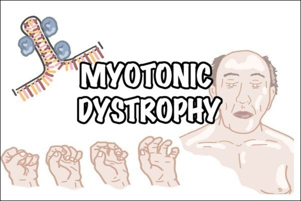 Myotonic dystrophy 