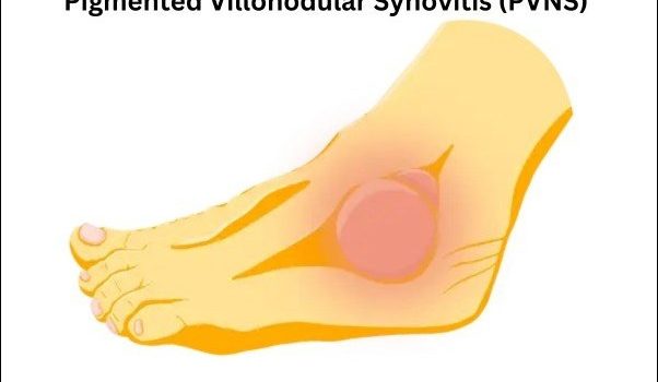 Pigmented Villonodular Synovitis (PVNS)