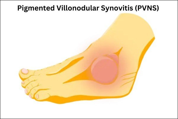 Pigmented Villonodular Synovitis (PVNS)