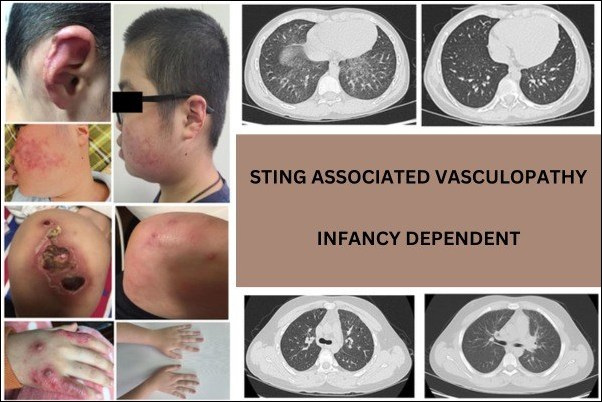 Sting Associated Vasculopathy, Infancy Dependent