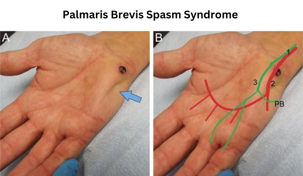 Palmaris Brevis Spasm Syndrome