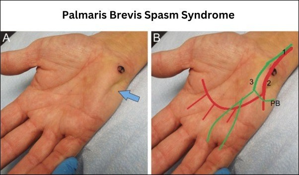 Palmaris Brevis Spasm Syndrome 