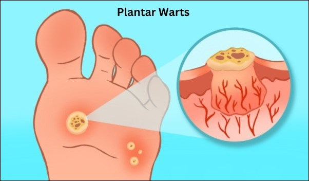Plantar Warts 