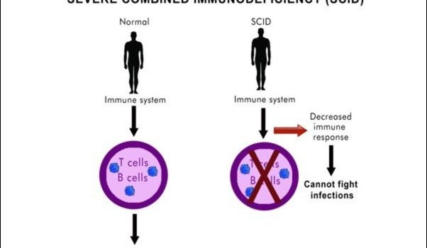 Severe Combined Immunodeficiency (SCID)