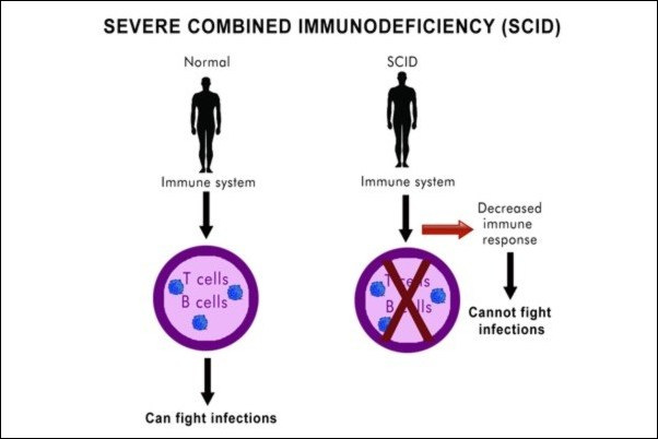 Severe Combined Immunodeficiency (SCID)